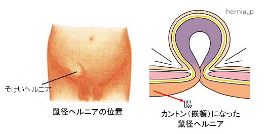 鼠径ヘルニアの症状