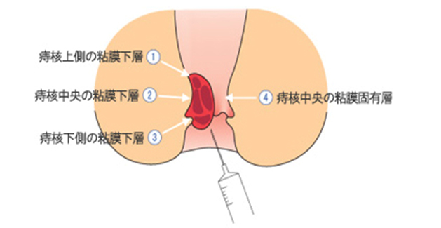 内痔核硬化療法（ジオン注）について