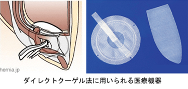 ダイレクトクーゲル法