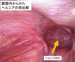 ヘルニアの突出部