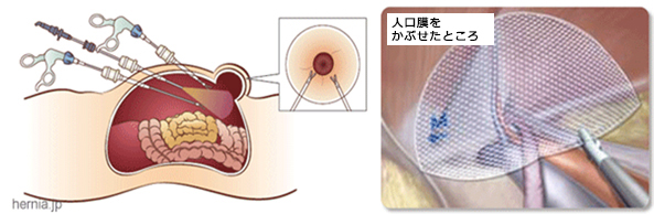 腹腔鏡下修復術（TAPP法）